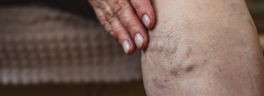 Varicose veins