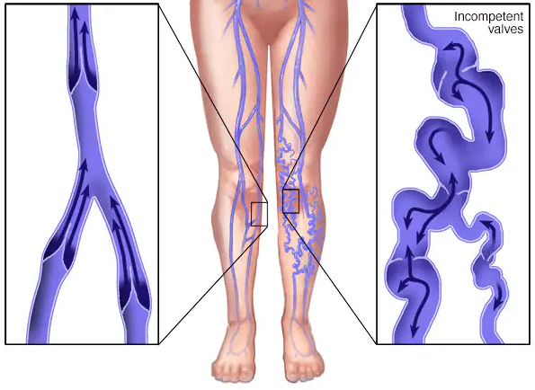 Varicose-Veins Varicose Vein Treatment Tampa FL