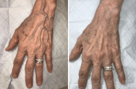 B&A 1 Before and After Hand Vein Treatment Tampa FL