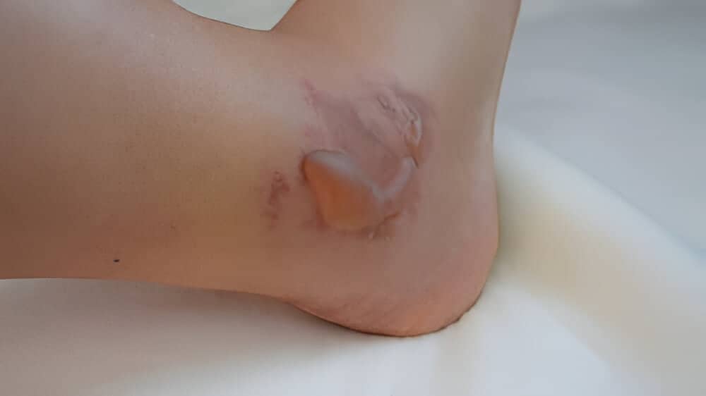 what-causes-swollen-legs-and-ankles Swollen Legs & Ankles Treatment Tampa FL